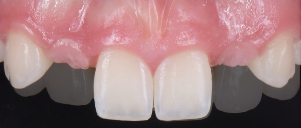 Three Solutions for Congenitally Missing Lateral Incisors: A Photo Essay RicardoMitrani 3SolutionsCongenitallyMissingLats Fig.23
