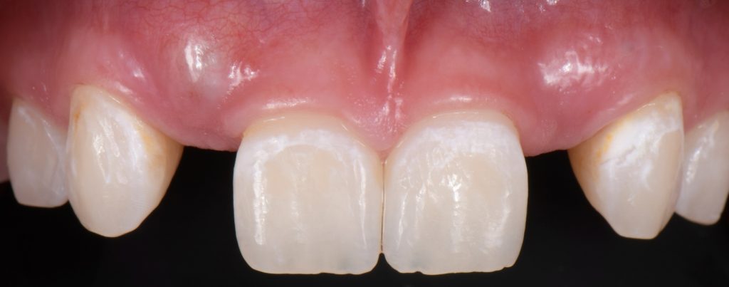 Three Solutions for Congenitally Missing Lateral Incisors: A Photo Essay RicardoMitrani 3SolutionsCongenitallyMissingLats Fig.3