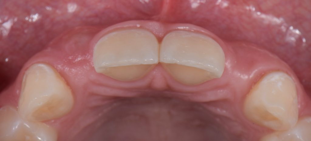 Three Solutions for Congenitally Missing Lateral Incisors: A Photo Essay RicardoMitrani 3SolutionsCongenitallyMissingLats Fig.4