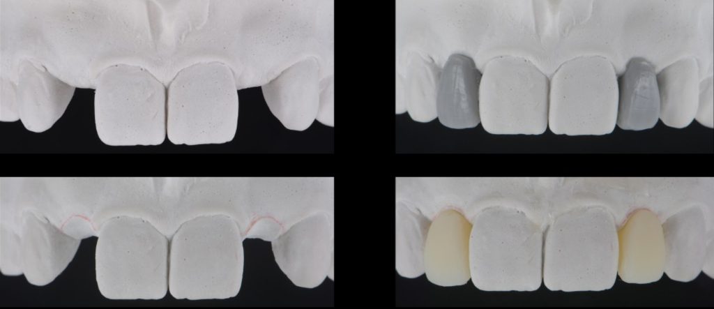 Three Solutions for Congenitally Missing Lateral Incisors: A Photo Essay RicardoMitrani 3SolutionsCongenitallyMissingLats Fig.5