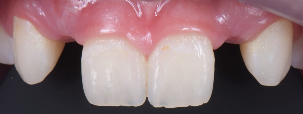 Three Solutions for Congenitally Missing Lateral Incisors: A Photo Essay RicardoMitrani 3SolutionsCongenitallyMissingLats Fig.6