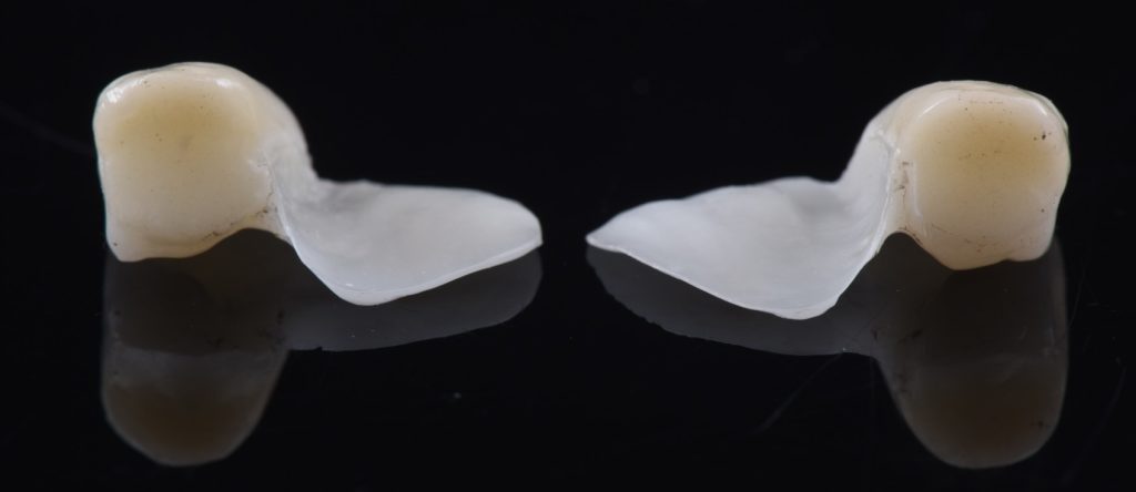 Three Solutions for Congenitally Missing Lateral Incisors: A Photo Essay RicardoMitrani 3SolutionsCongenitallyMissingLats Fig.9