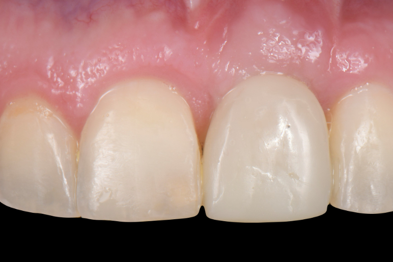 Customized Impression Coping for a Single Tooth Implant in a Maxillary Central Incisor RicardoMitrani CustImpressCopingSingleTooth Fig.1