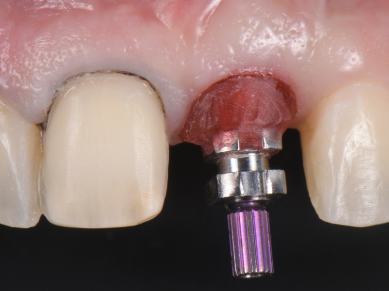 Customized Impression Coping for a Single Tooth Implant in a Maxillary Central Incisor RicardoMitrani CustImpressCopingSingleTooth Fig.11