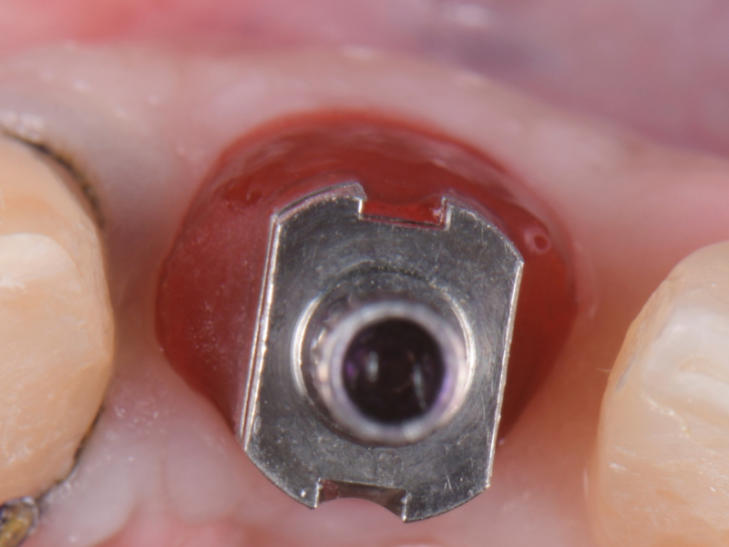 Customized Impression Coping for a Single Tooth Implant in a Maxillary Central Incisor RicardoMitrani CustImpressCopingSingleTooth Fig.12