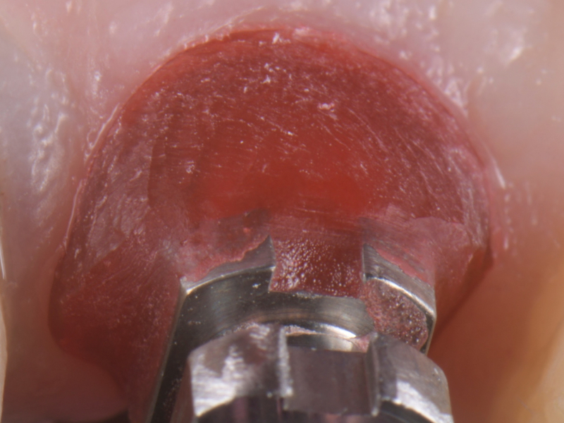 Customized Impression Coping for a Single Tooth Implant in a Maxillary Central Incisor RicardoMitrani CustImpressCopingSingleTooth Fig.13