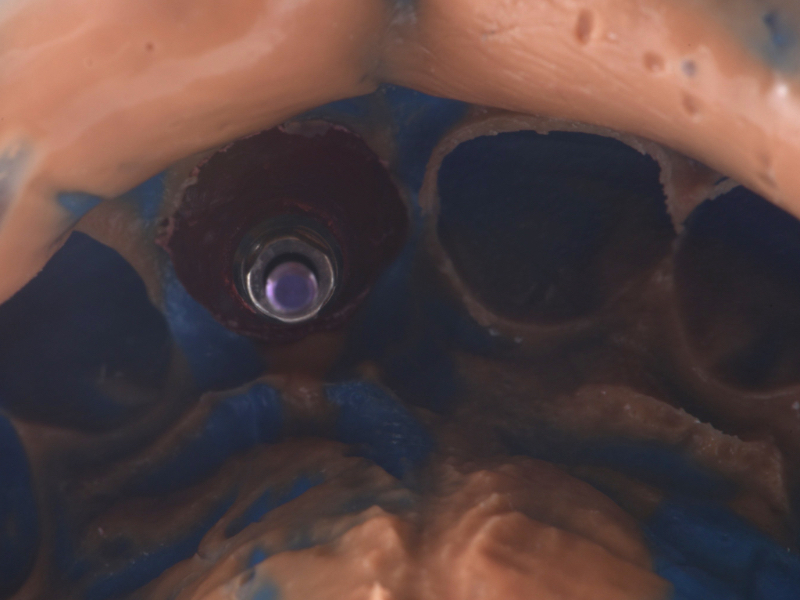 Customized Impression Coping for a Single Tooth Implant in a Maxillary Central Incisor RicardoMitrani CustImpressCopingSingleTooth Fig.14