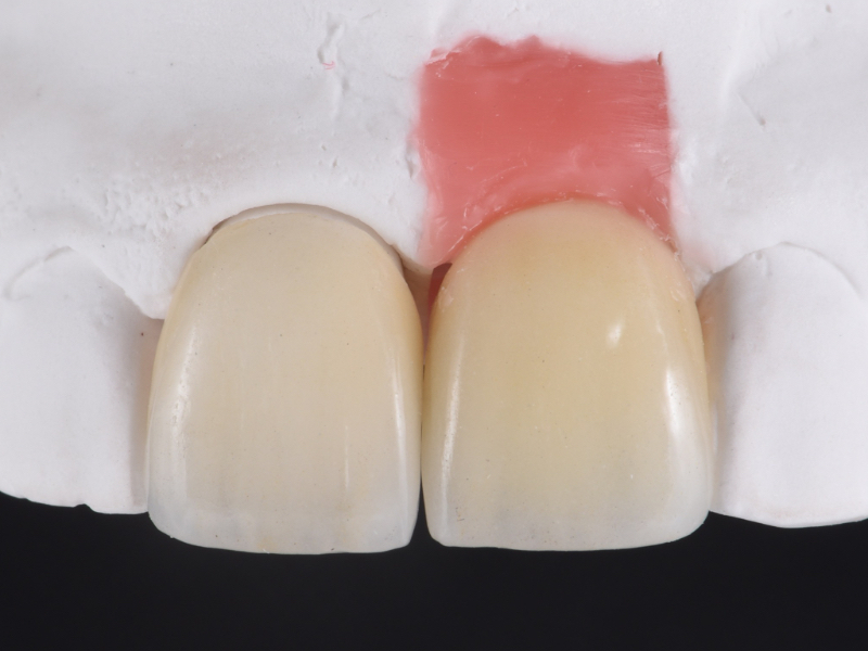 Customized Impression Coping for a Single Tooth Implant in a Maxillary Central Incisor RicardoMitrani CustImpressCopingSingleTooth Fig.15