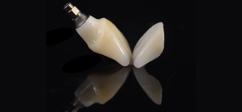 Customized Impression Coping for a Single Tooth Implant in a Maxillary Central Incisor RicardoMitrani CustImpressCopingSingleTooth Fig.16