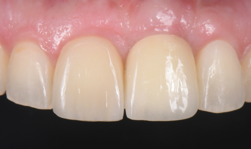 Customized Impression Coping for a Single Tooth Implant in a Maxillary Central Incisor RicardoMitrani CustImpressCopingSingleTooth Fig.17