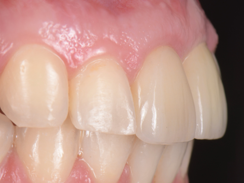 Customized Impression Coping for a Single Tooth Implant in a Maxillary Central Incisor RicardoMitrani CustImpressCopingSingleTooth Fig.18
