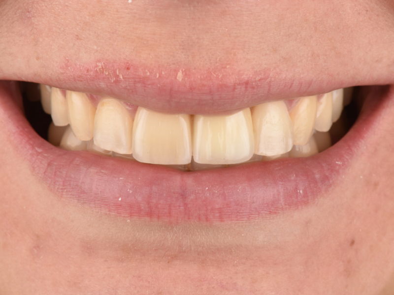 Customized Impression Coping for a Single Tooth Implant in a Maxillary Central Incisor RicardoMitrani CustImpressCopingSingleTooth Fig.19