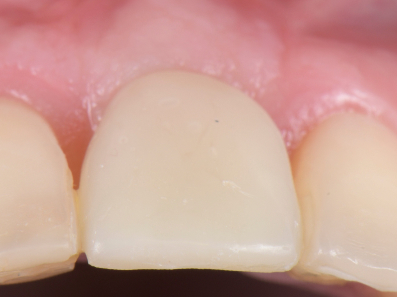 Customized Impression Coping for a Single Tooth Implant in a Maxillary Central Incisor RicardoMitrani CustImpressCopingSingleTooth Fig.2