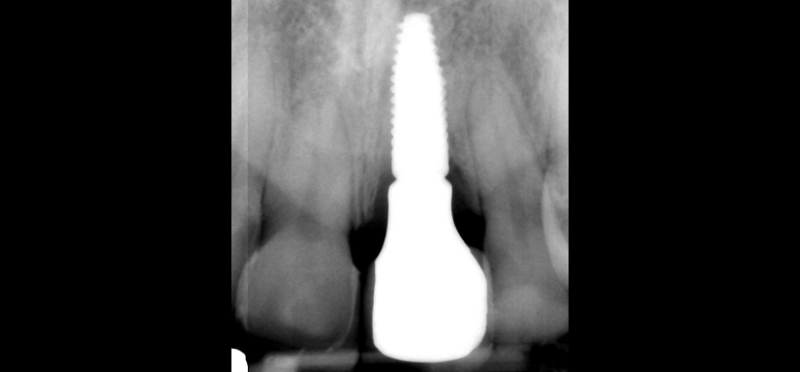 Customized Impression Coping for a Single Tooth Implant in a Maxillary Central Incisor RicardoMitrani CustImpressCopingSingleTooth Fig.20