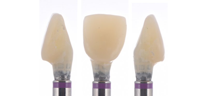 Customized Impression Coping for a Single Tooth Implant in a Maxillary Central Incisor RicardoMitrani CustImpressCopingSingleTooth Fig.3