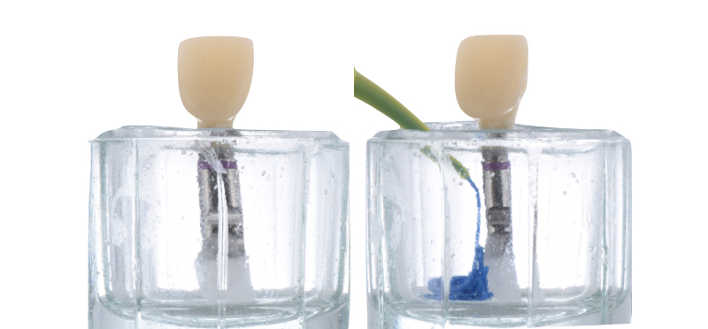 Customized Impression Coping for a Single Tooth Implant in a Maxillary Central Incisor RicardoMitrani CustImpressCopingSingleTooth Fig.4