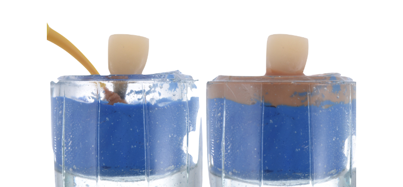 Customized Impression Coping for a Single Tooth Implant in a Maxillary Central Incisor RicardoMitrani CustImpressCopingSingleTooth Fig.5