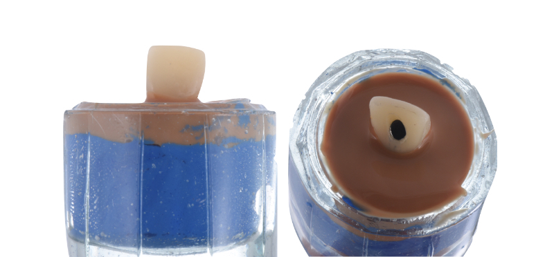 Customized Impression Coping for a Single Tooth Implant in a Maxillary Central Incisor RicardoMitrani CustImpressCopingSingleTooth Fig.6