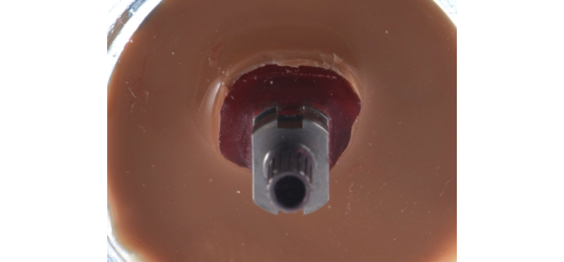Customized Impression Coping for a Single Tooth Implant in a Maxillary Central Incisor RicardoMitrani CustImpressCopingSingleTooth Fig.8