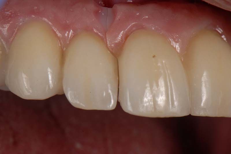 How to Temporarily Repair a Fractured Implant-Supported Zirconia Prosthesis RicardoMitrani TempRepairFracturedImplantZirconia Fig.1
