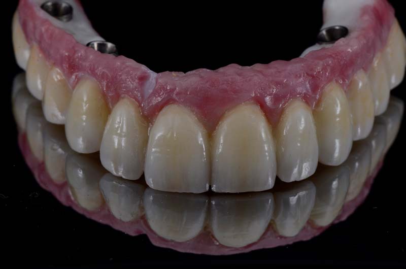 How to Temporarily Repair a Fractured Implant-Supported Zirconia Prosthesis RicardoMitrani TempRepairFracturedImplantZirconia Fig.10