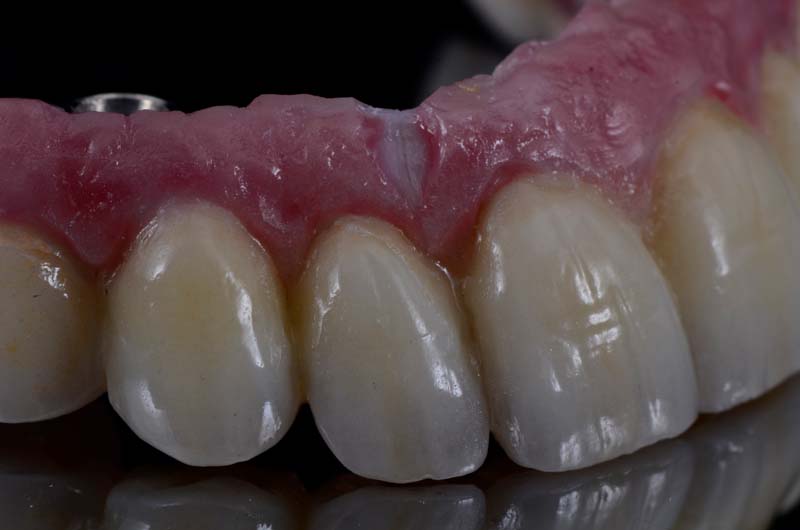 How to Temporarily Repair a Fractured Implant-Supported Zirconia Prosthesis RicardoMitrani TempRepairFracturedImplantZirconia Fig.11