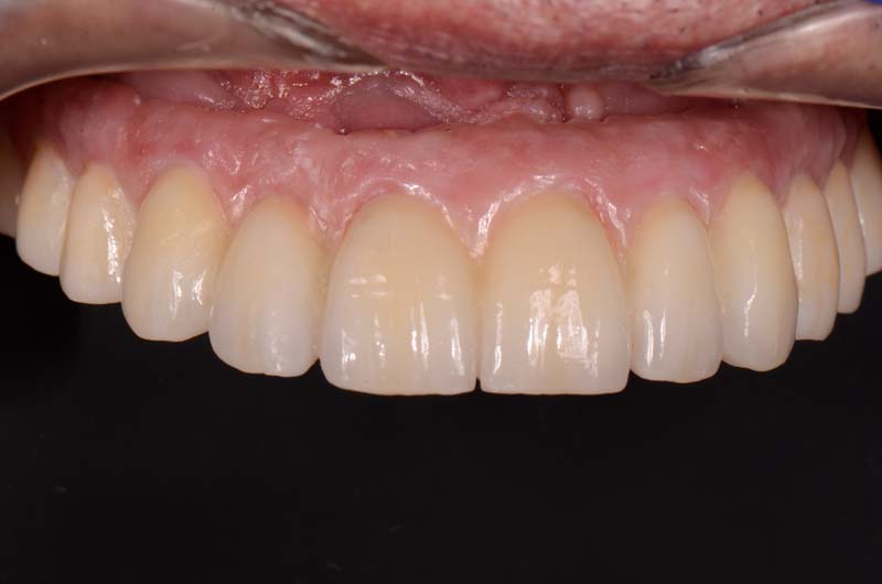 How to Temporarily Repair a Fractured Implant-Supported Zirconia Prosthesis RicardoMitrani TempRepairFracturedImplantZirconia Fig.12