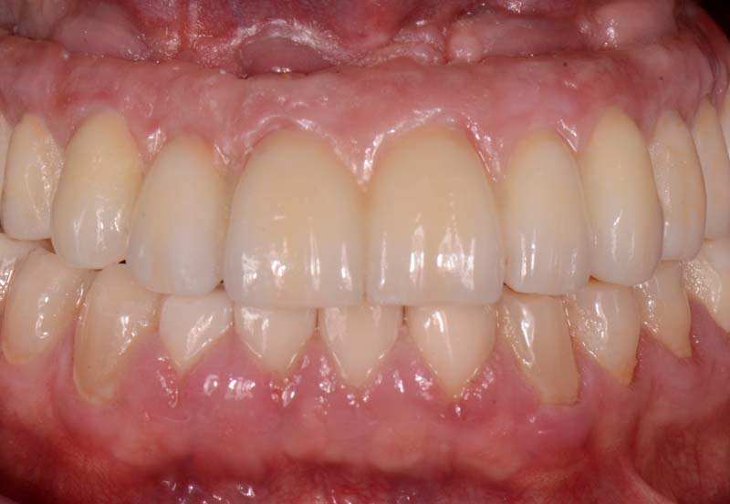 How to Temporarily Repair a Fractured Implant-Supported Zirconia Prosthesis RicardoMitrani TempRepairFracturedImplantZirconia Fig.13