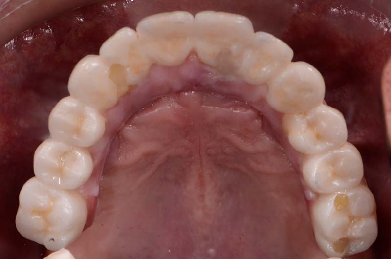 How to Temporarily Repair a Fractured Implant-Supported Zirconia Prosthesis RicardoMitrani TempRepairFracturedImplantZirconia Fig.14