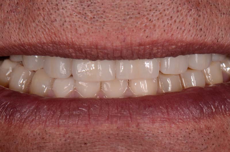 How to Temporarily Repair a Fractured Implant-Supported Zirconia Prosthesis RicardoMitrani TempRepairFracturedImplantZirconia Fig.15