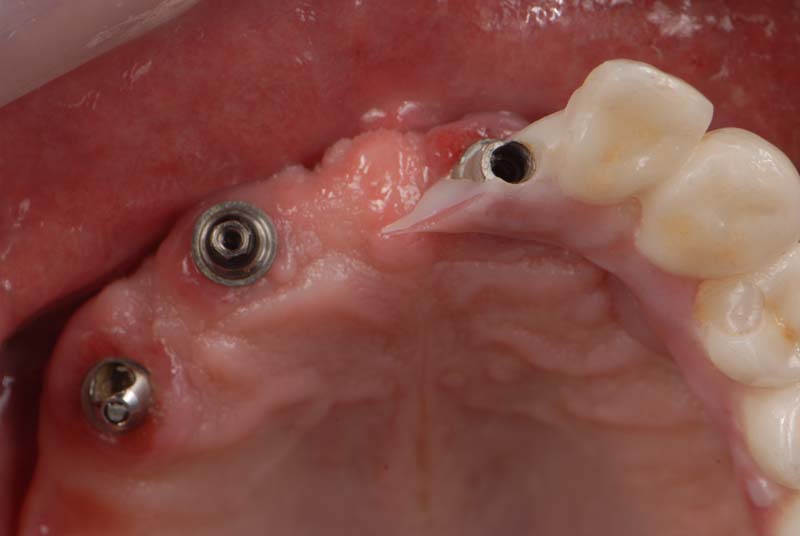 How to Temporarily Repair a Fractured Implant-Supported Zirconia Prosthesis RicardoMitrani TempRepairFracturedImplantZirconia Fig.2