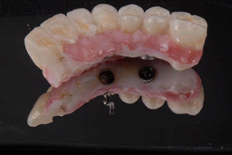 How to Temporarily Repair a Fractured Implant-Supported Zirconia Prosthesis RicardoMitrani TempRepairFracturedImplantZirconia Fig.3