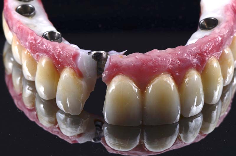 How to Temporarily Repair a Fractured Implant-Supported Zirconia Prosthesis RicardoMitrani TempRepairFracturedImplantZirconia Fig.5