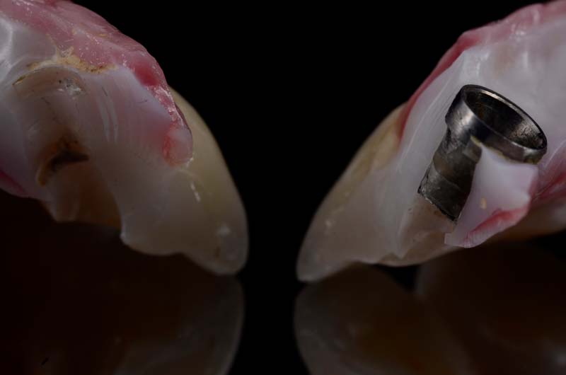 How to Temporarily Repair a Fractured Implant-Supported Zirconia Prosthesis RicardoMitrani TempRepairFracturedImplantZirconia Fig.6