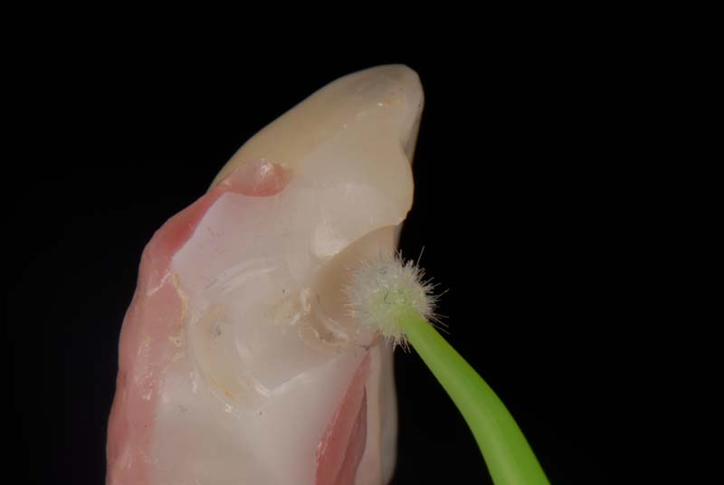 How to Temporarily Repair a Fractured Implant-Supported Zirconia Prosthesis RicardoMitrani TempRepairFracturedImplantZirconia Fig.8