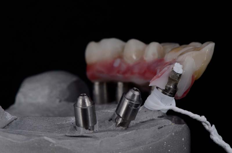 How to Temporarily Repair a Fractured Implant-Supported Zirconia Prosthesis RicardoMitrani TempRepairFracturedImplantZirconia Fig.9