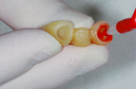 Acid Etching of Ceramic Before Bonding Robert Winter Acid Etching of Ceramic Before Bonding Featured Image