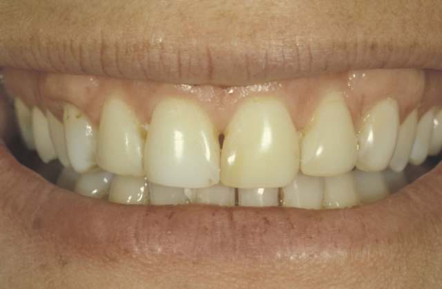 Glass Ceramic Bonding: 3 Commonly Asked Questions Robert Winter Glass Ceramic Bonding Figure 1