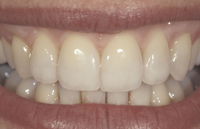 Glass Ceramic Bonding: 3 Commonly Asked Questions Robert Winter Glass Ceramic Bonding Figure 3