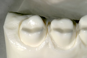 Posterior Full-Contour Zirconia Crowns: Preparation Design Robert Winter Posterior Full contour Zirconia Crowns Figure 1
