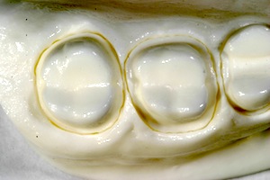 Posterior Full-Contour Zirconia Crowns: Preparation Design Robert Winter Posterior Full contour Zirconia Crowns Figure 2
