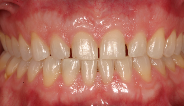 A Simplified Process for Bonding e.max and Other Glass Ceramic Restorations Robert Winter Process for Bonding e.max and Other Glass Ceramic Restorations figure 1