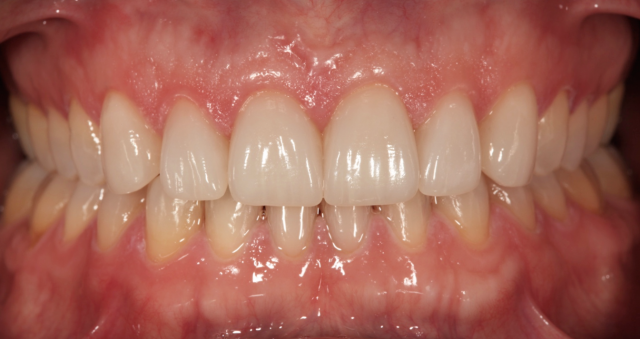 A Simplified Process for Bonding e.max and Other Glass Ceramic Restorations Robert Winter Process for Bonding e.max and Other Glass Ceramic Restorations figure 3