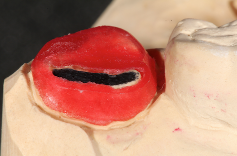 Understanding Reduction Copings Robert Winter Understanding Reduction Copings Featured Image