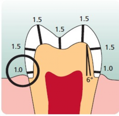 Why Do e.max Crowns Fracture? Robert Winter Why Do e.max Crowns Fracture Figure 1
