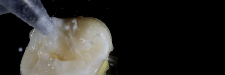 Planning the Class IV: Workhorse of Cosmetic Dentistry, Part 2