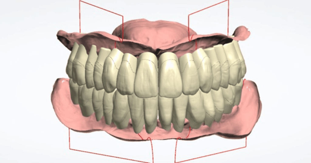 その他 Imai Method Complete Denture The Reference Denture