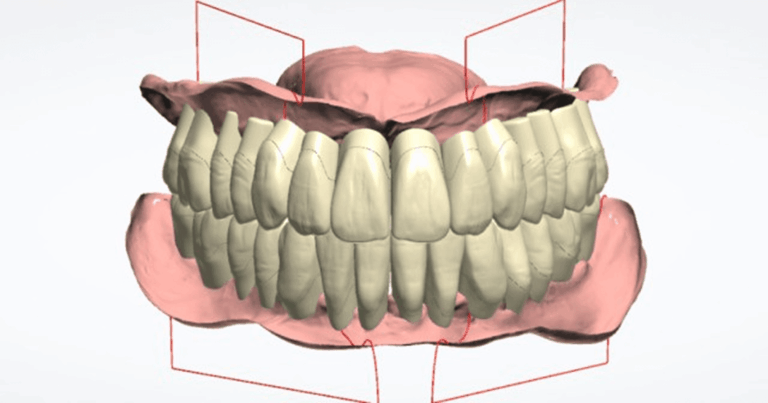 The Reference Denture Technique An Interdisciplinary Case Study