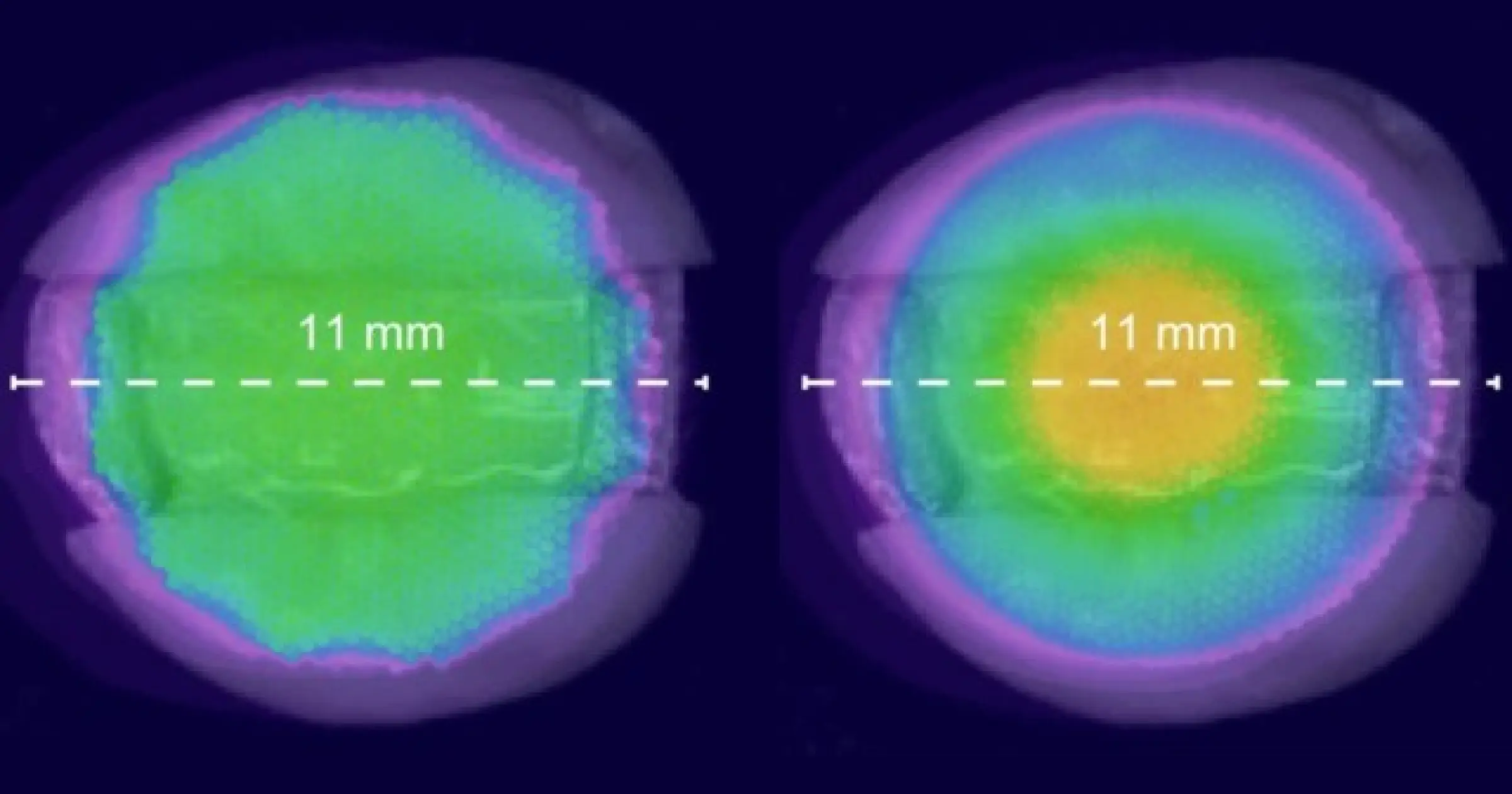 The Wizardry of Light Curing Adhesive Resin