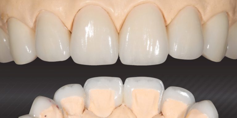 Interproximal Contacts: Assessment and Adjustment